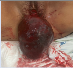 a) Showing the prolapsed uterus with swelling, ulcers, and sloughed